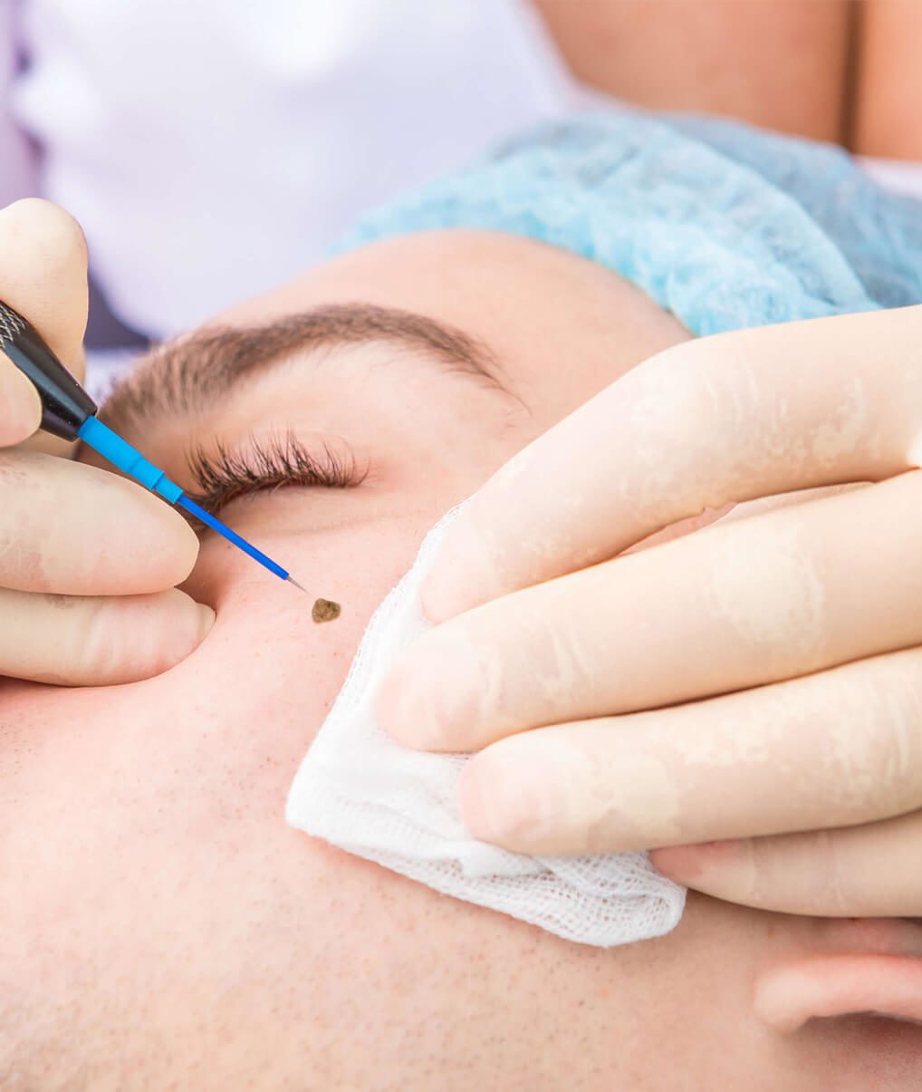 Electrocirugia Electrodos de Radiofrecuencia de Alta Precisión